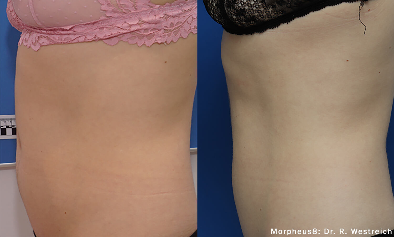 Morpheus8 Before and After