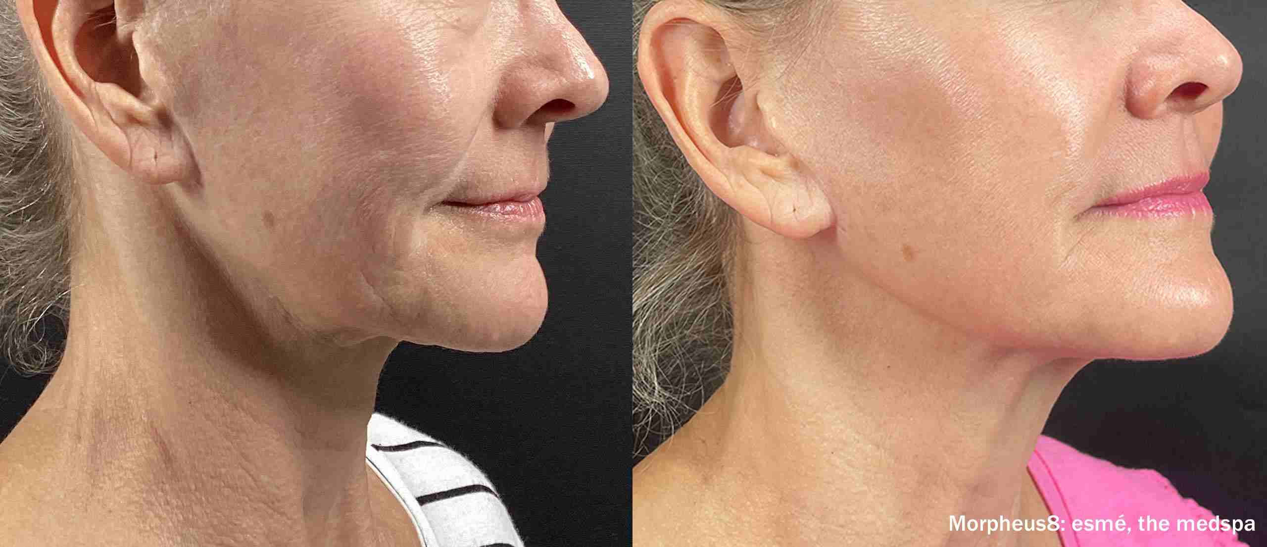 Morpheus8 Before and After