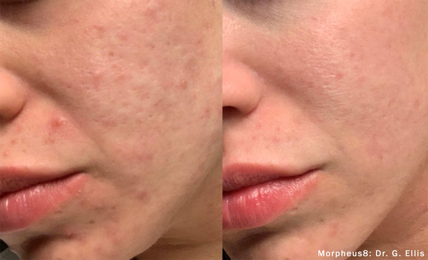 Morpheus8 Before and After