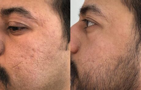 UltraClear - Before and After Acne
