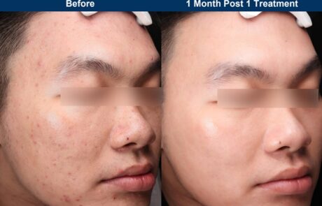 UltraClear - Before and After Acne Scaring