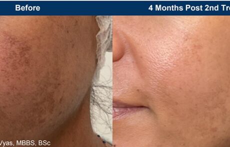 UltraClear - Before and After Hyperpigrmentation