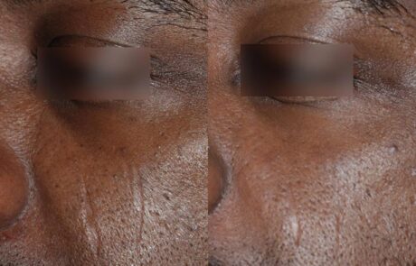 UltraClear - Before and After Scar