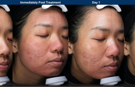 UltraClear - Before and After additional