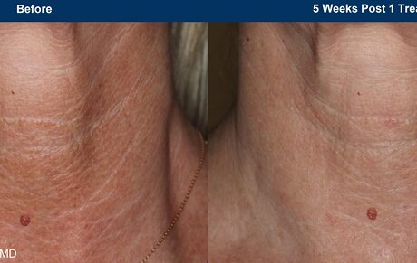 UltraClear - Before and after laser fine lines wrinkles - neck