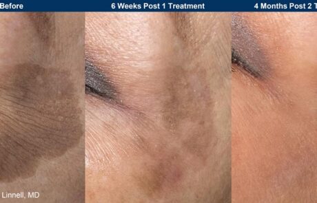 UltraClear - Before and after pigmentation