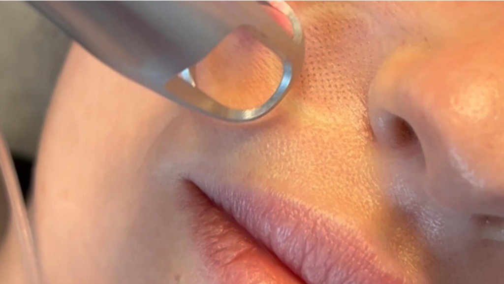 UltraClear - Why Choose La Réserve NYC for UltraClear