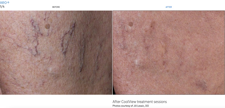 Xeo+ - Before and After