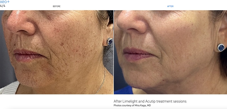 Xeo+ - Before and After