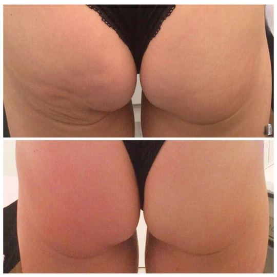 body-skin-tightening-before-and-after