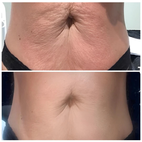t-shape2-before-after