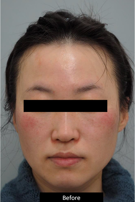 Derma-V-Treatments in NYC at La Réserve