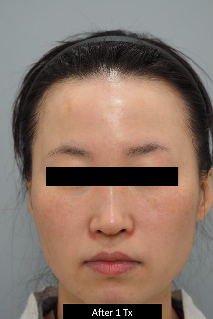 BEFORE AND AFTER DERMA V™