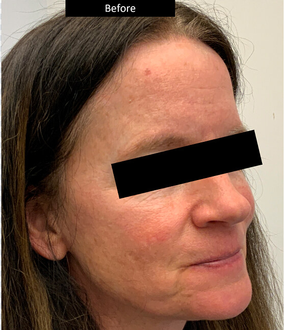 BEFORE AND AFTER DERMA V™