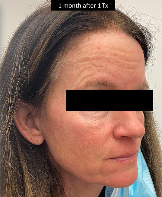 BEFORE AND AFTER DERMAV™