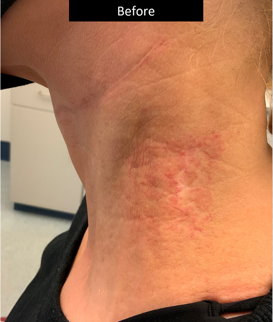 BEFORE AND AFTER DERMA V™