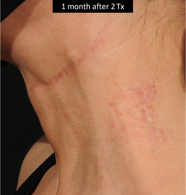 BEFORE AND AFTER DERMA V™
